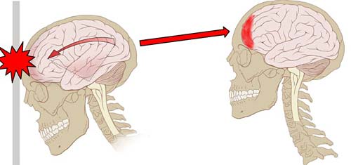 concussion-impact